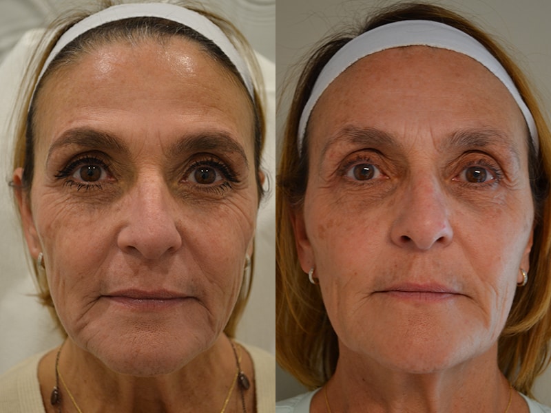 bbl before and after laser treatment and dermal fillers for 60 to 65 year old woman, fixing pigmentation and tightening skin