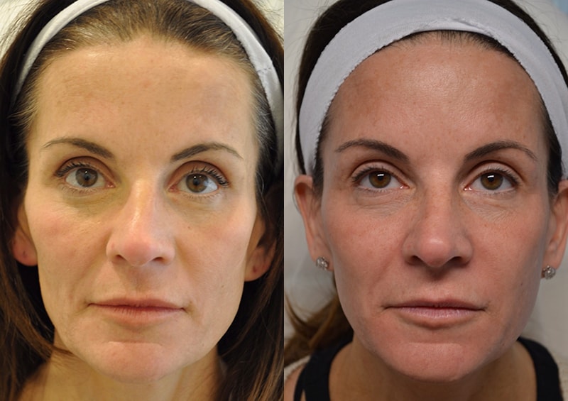 dermal filler before and after of woman aged 45 to 50 with concerns about cheeks and temples