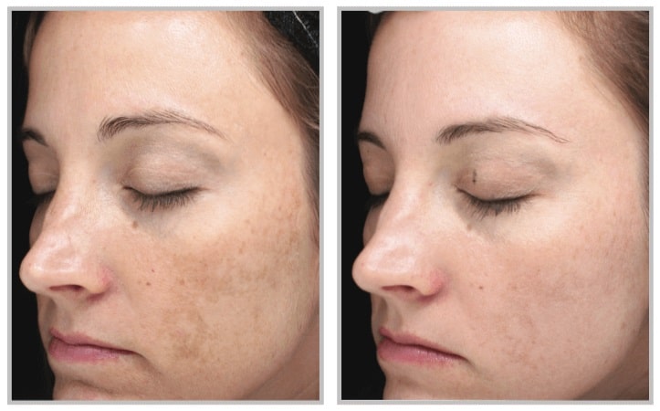 halo laser before and after for woman, clearing dark spots on face