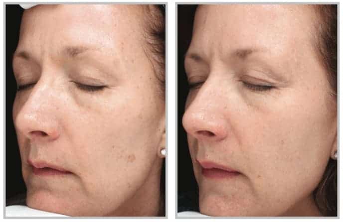 halo laser before and after for woman's face, clearing dark spots