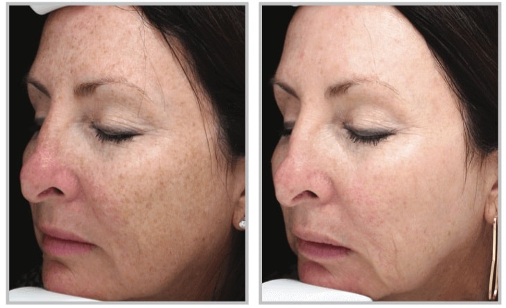 halo laser before and after for woman's face, lightening cheeks and forehead