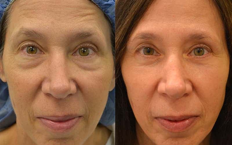woman aged 60 to 65 before and after bilaterial lower eyelid blepharoplasty