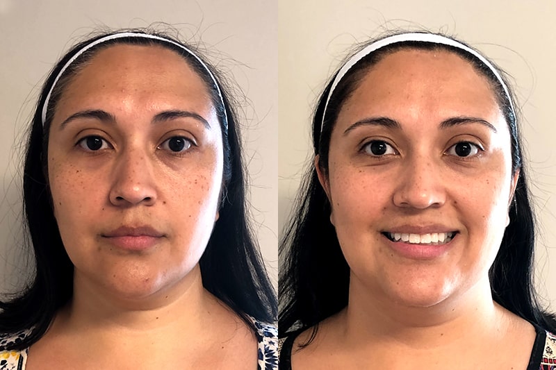 microneedling before and after of young woman