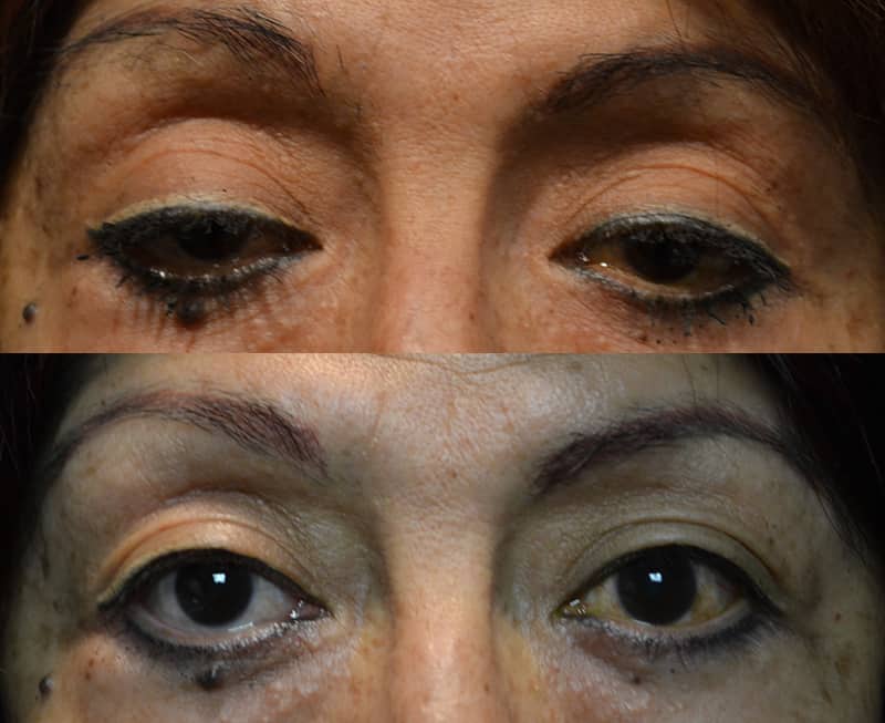 ptosis before and after results for a woman aged 55 to 60