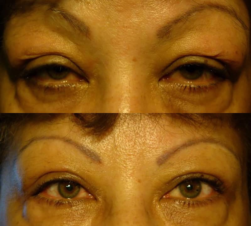 ptosis surgery before and after results for a woman aged 50 to 55