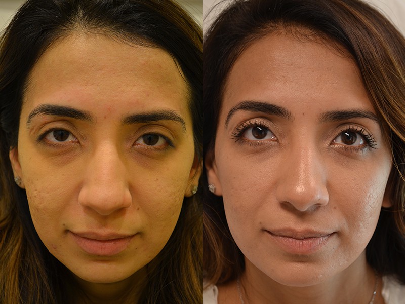 bilateral droopy eyelid surgery before and after of woman aged 30 to 35