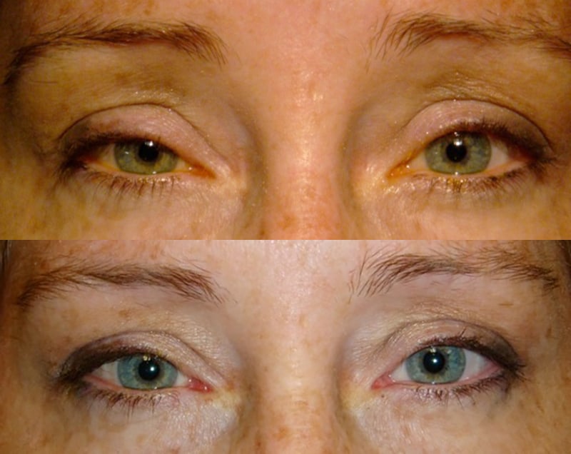 lazy eyelid surgery before and after results for a woman aged 45 to 50
