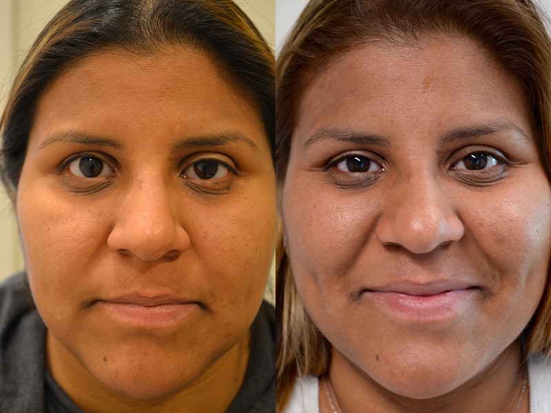 ptosis surgery before and after of woman aged 30 to 35