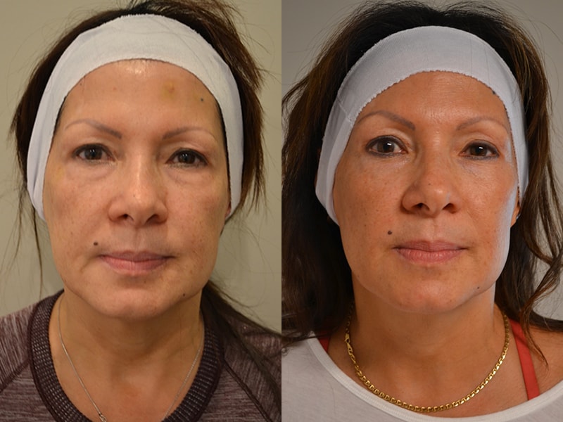 before and after of woman's ultherapy treatment for lower face and upper neck