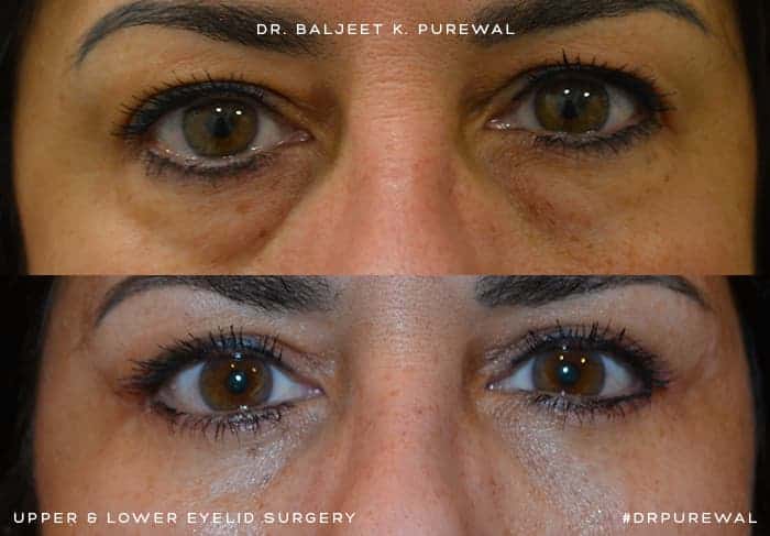 woman with brown eyes before and after for upper and lower blepharoplasty