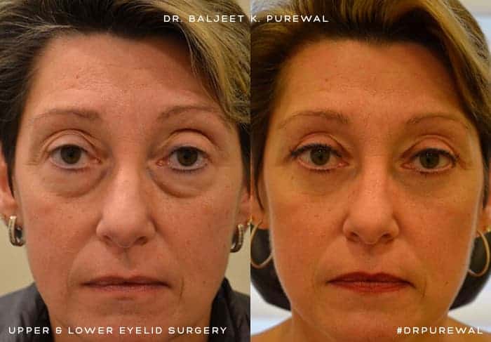 upper and lower blepharoplasty before and after for woman with brown eyes