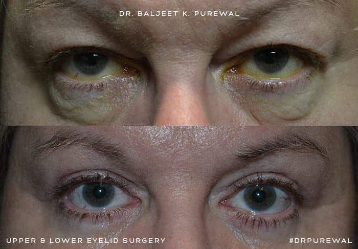 upper and lower blepharoplasty before and after for man with blue eyes