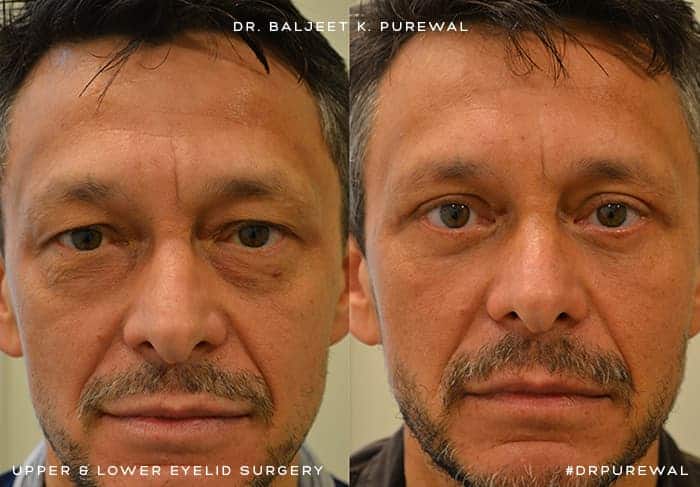 full face upper and lower blepharoplasty before and after of man with brown eyes and a beard