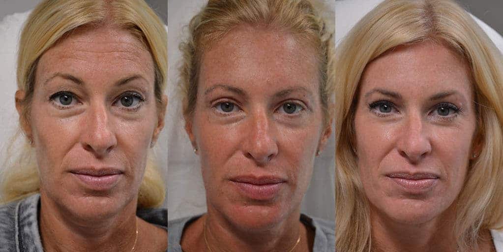 woman's upper blepharoplasty before and after results at one week and one month post-procedure