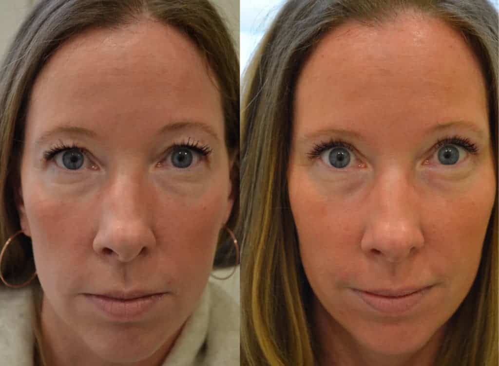 bilateral upper eyelid surgery before and after photo of a woman aged 40 to 45