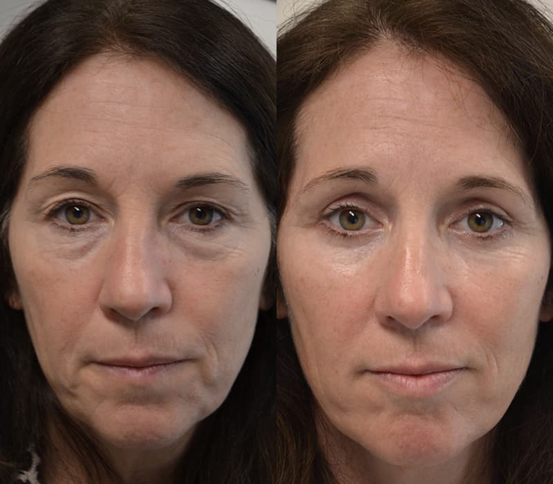 lower and upper blepharoplasty before and after of woman aged 50 to 55
