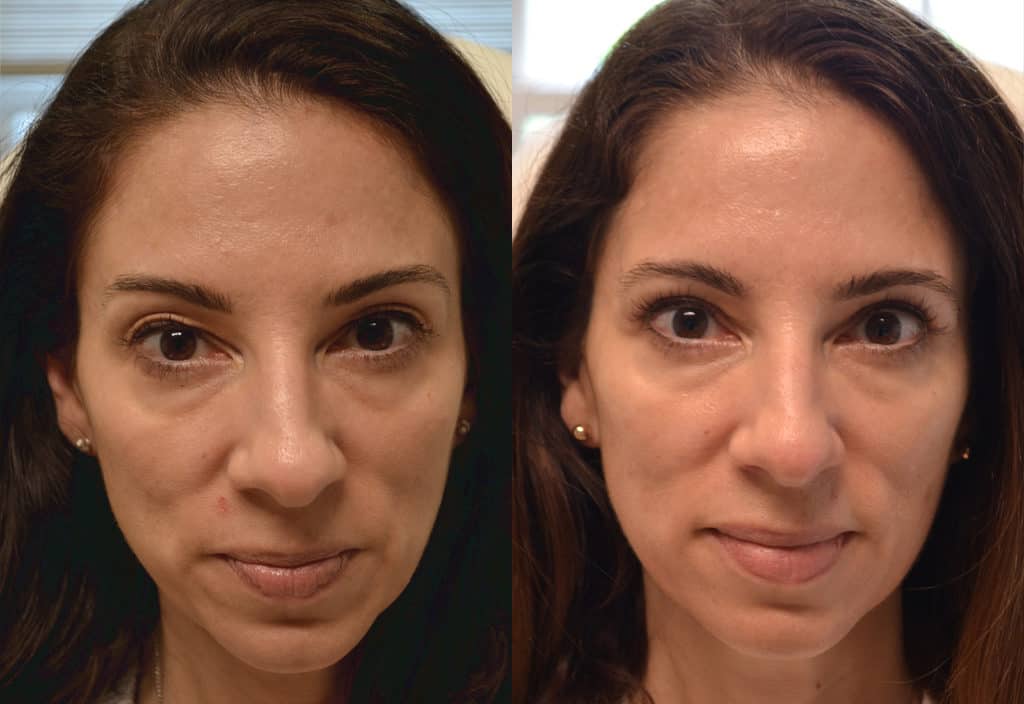 woman's upper blepharoplasty before & after