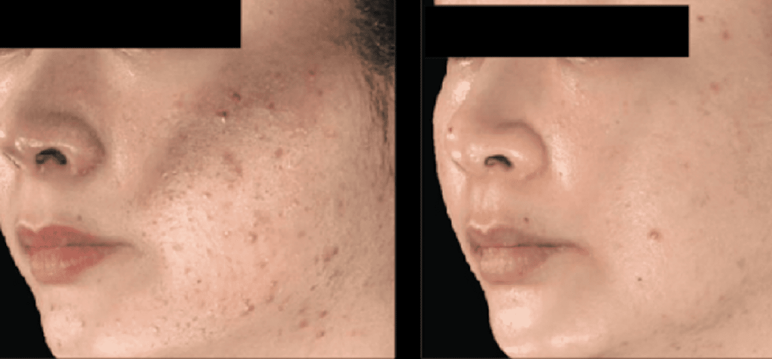 Sylfirm X Radio Frequency (RF) Microneedling FRESH FACE + EYE